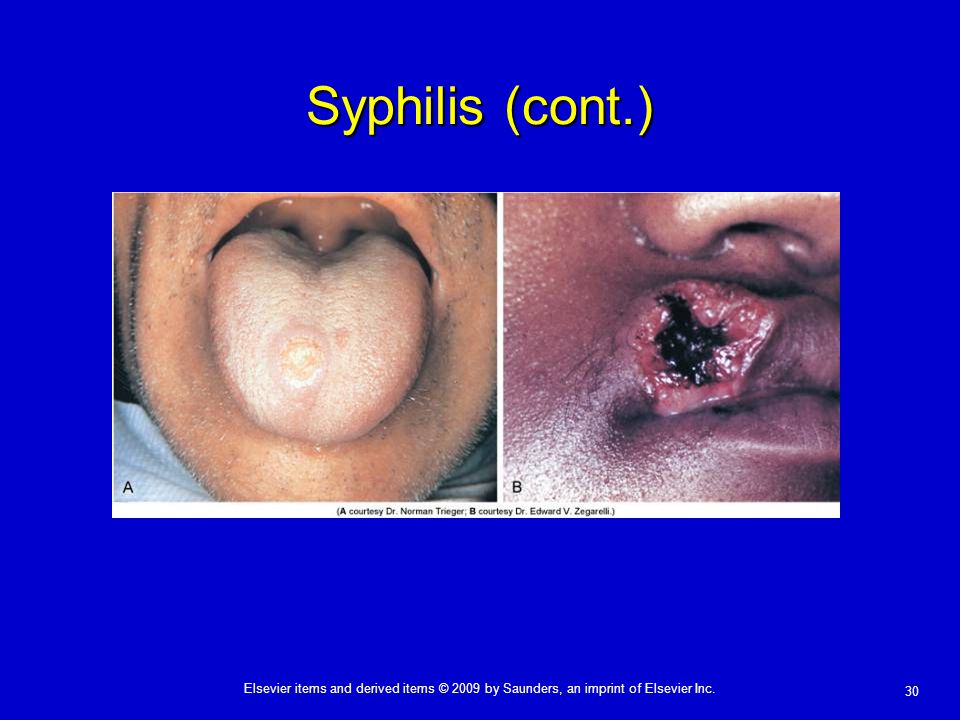 Syphilis (cont.)