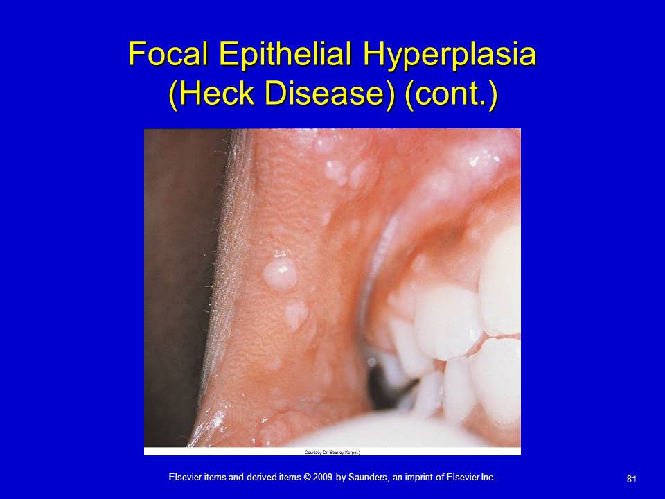 Focal Epithelial Hyperplasia (Heck Disease) (cont.)