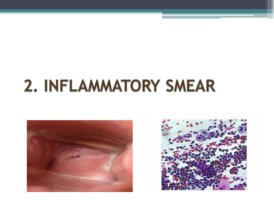 Management Of Abnormal Pap Smear - Ppt Video Online Download