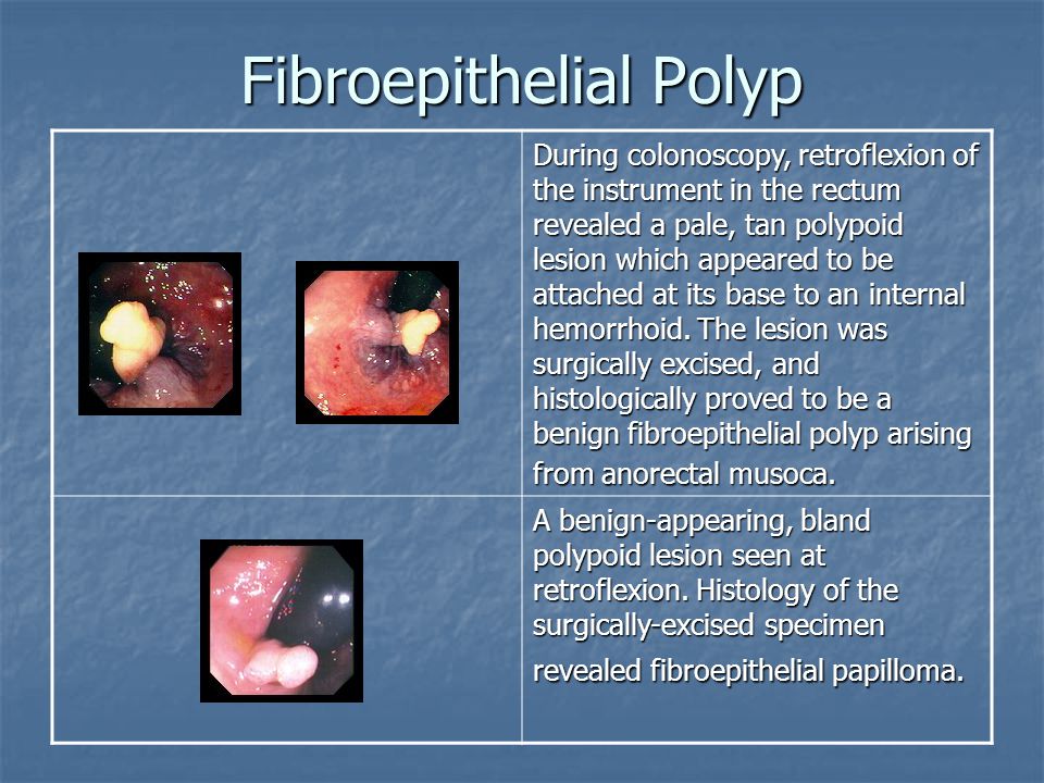 define fibroepithelial papilloma