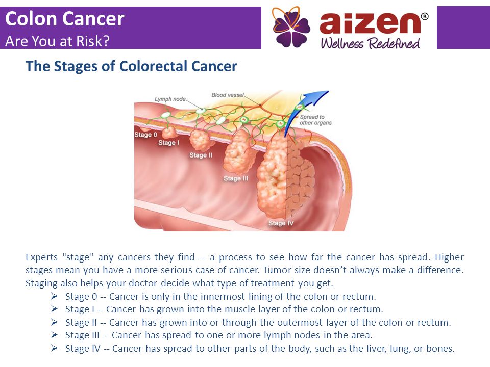 Colon Cancer Are You at Risk The Stages of Colorectal Cancer