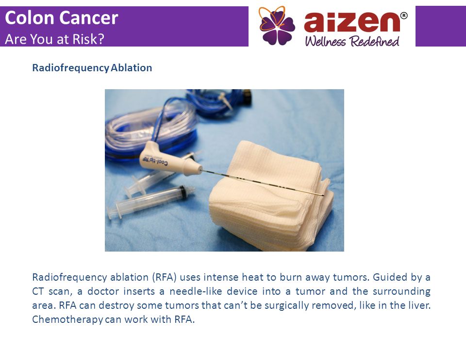 Colon Cancer Are You at Risk Radiofrequency Ablation