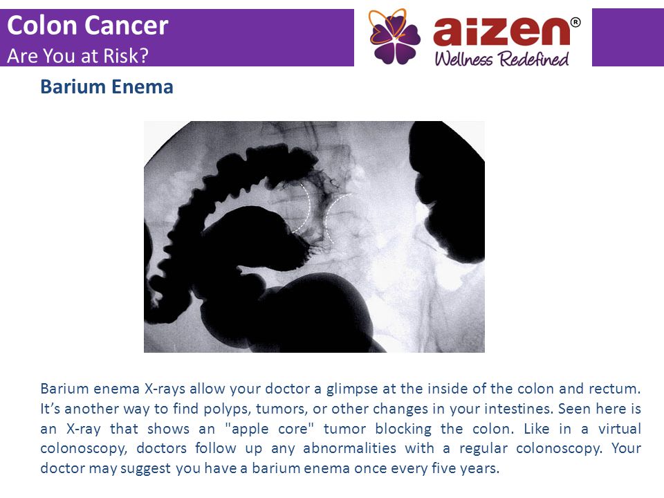 Colon Cancer Are You at Risk Barium Enema