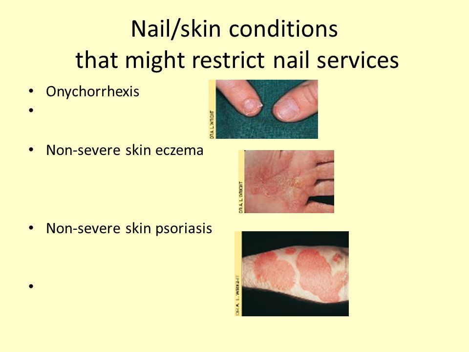 Top 141+ contraindications of nail care best songngunhatanh.edu.vn