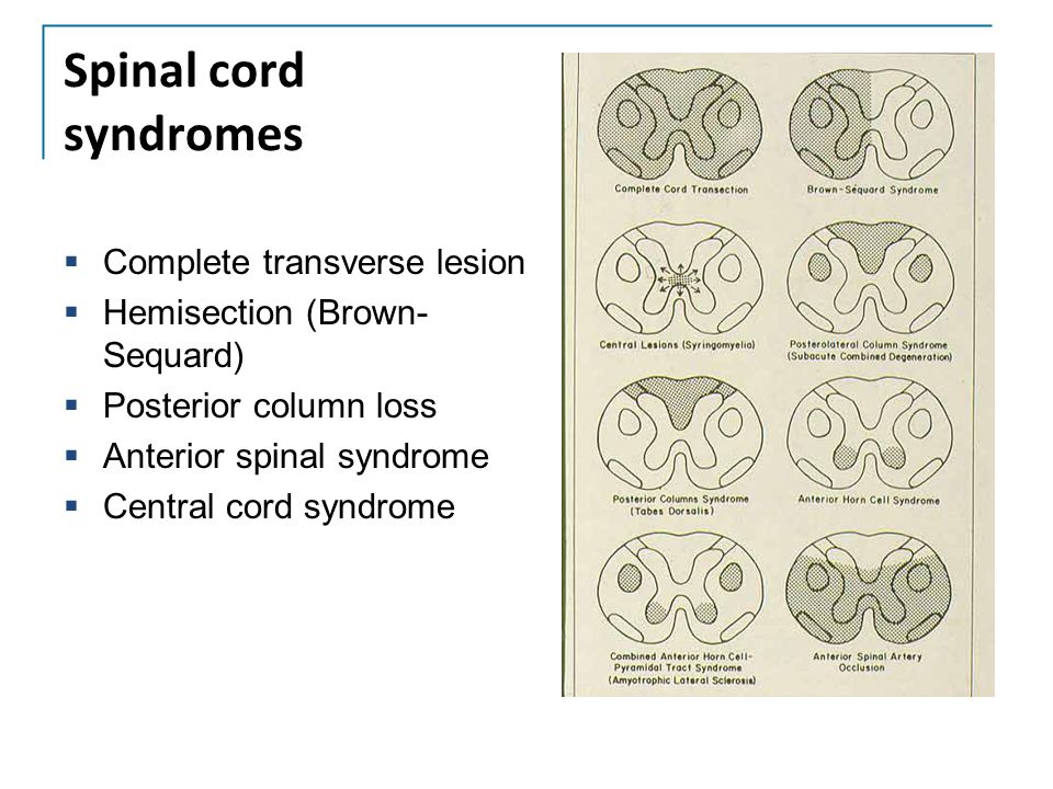 Spinal cord syndromes Complete transverse lesion
