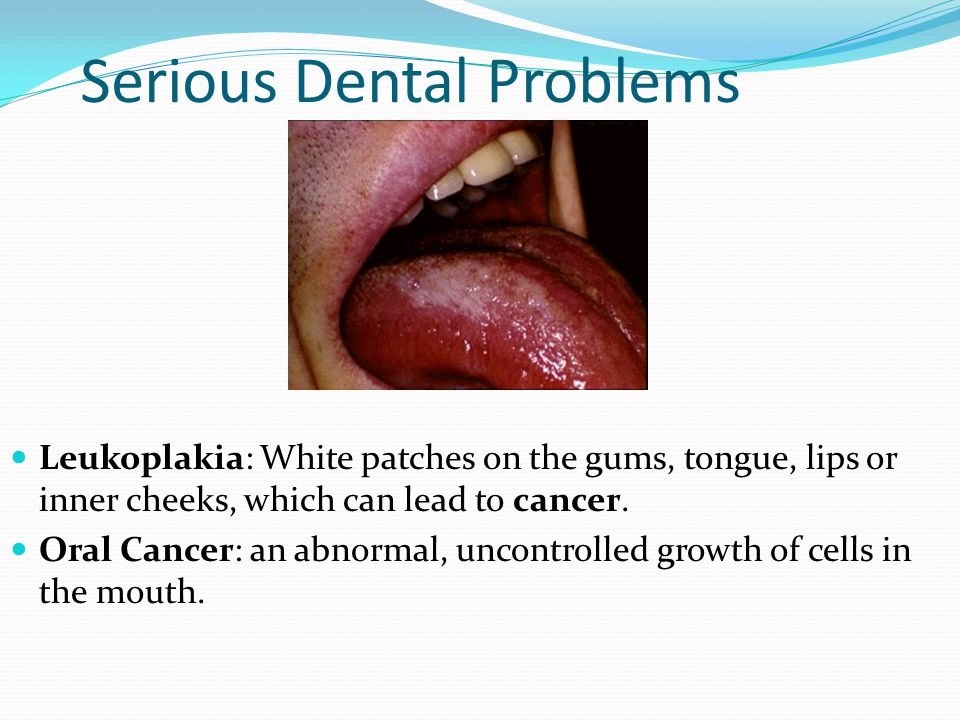 Serious Dental Problems