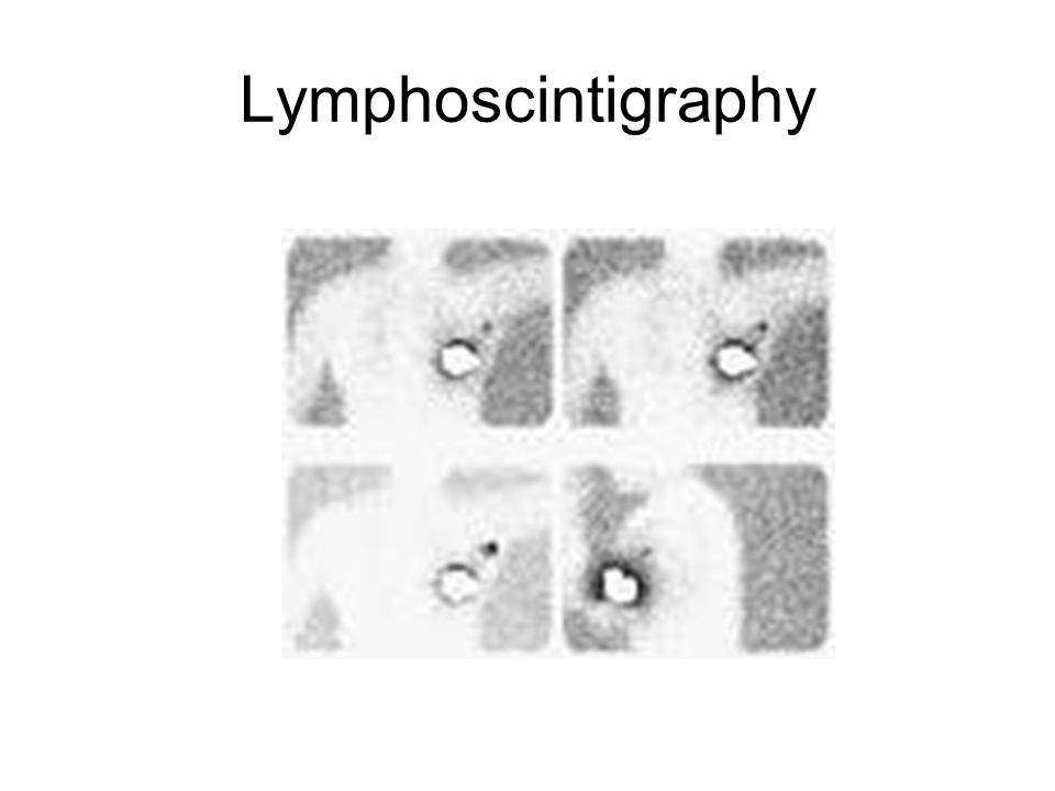 Lymphoscintigraphy
