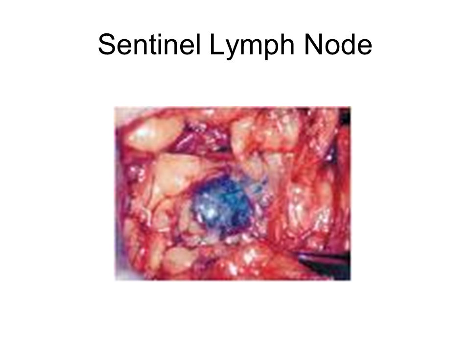 Sentinel Lymph Node