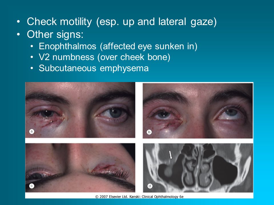 Back to Basics: Diplopia - ppt video online download