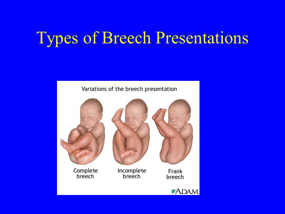 Types of Breech Presentations