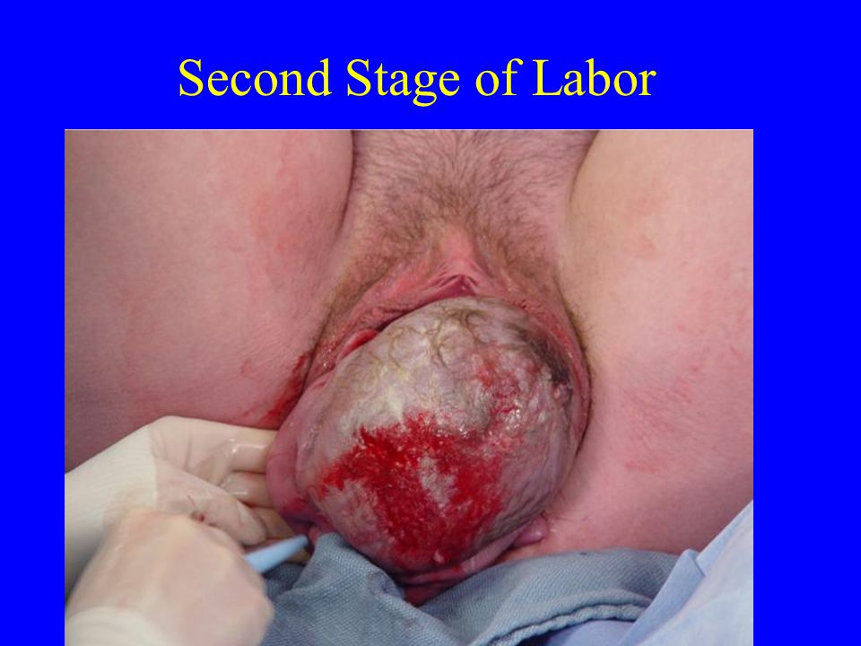 Second Stage of Labor