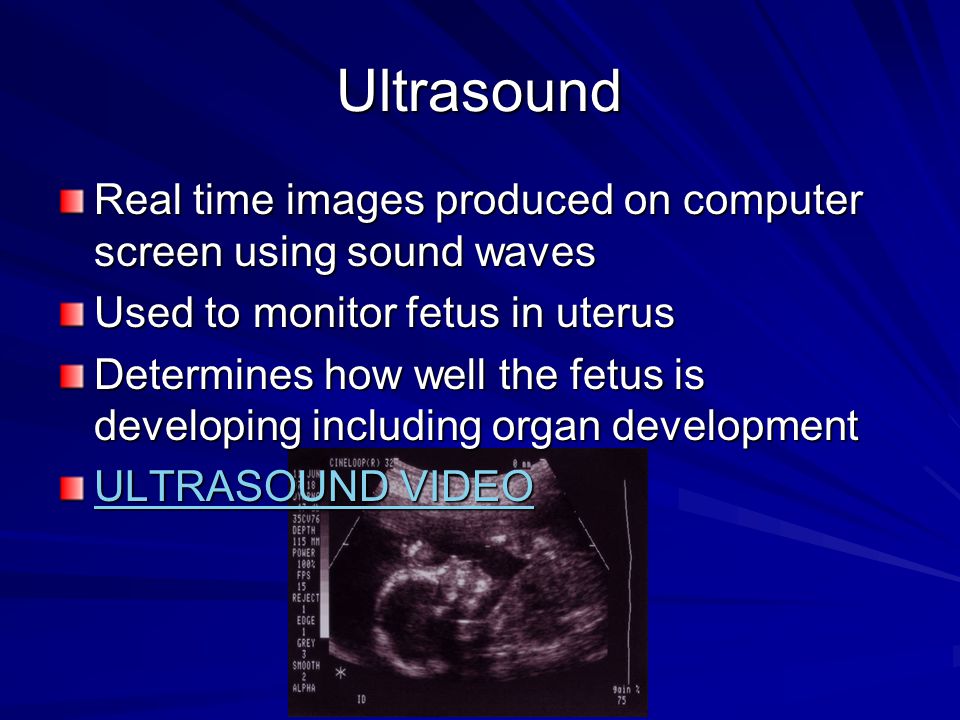 Ultrasound Real time images produced on computer screen using sound waves. Used to monitor fetus in uterus.