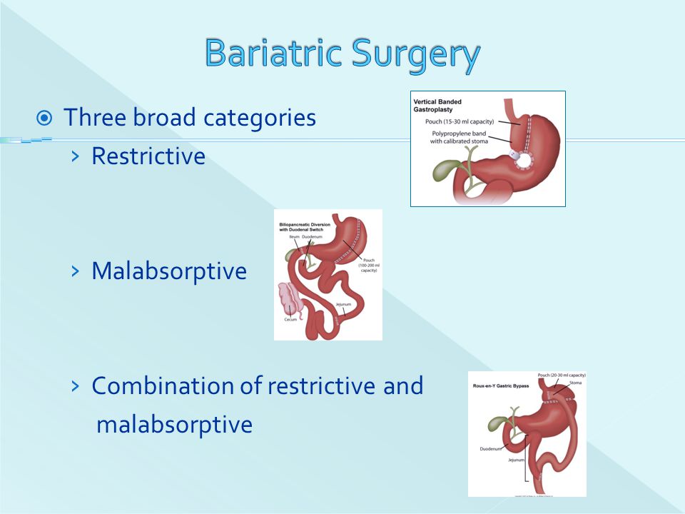 Bariatric Surgery Three broad categories Restrictive Malabsorptive