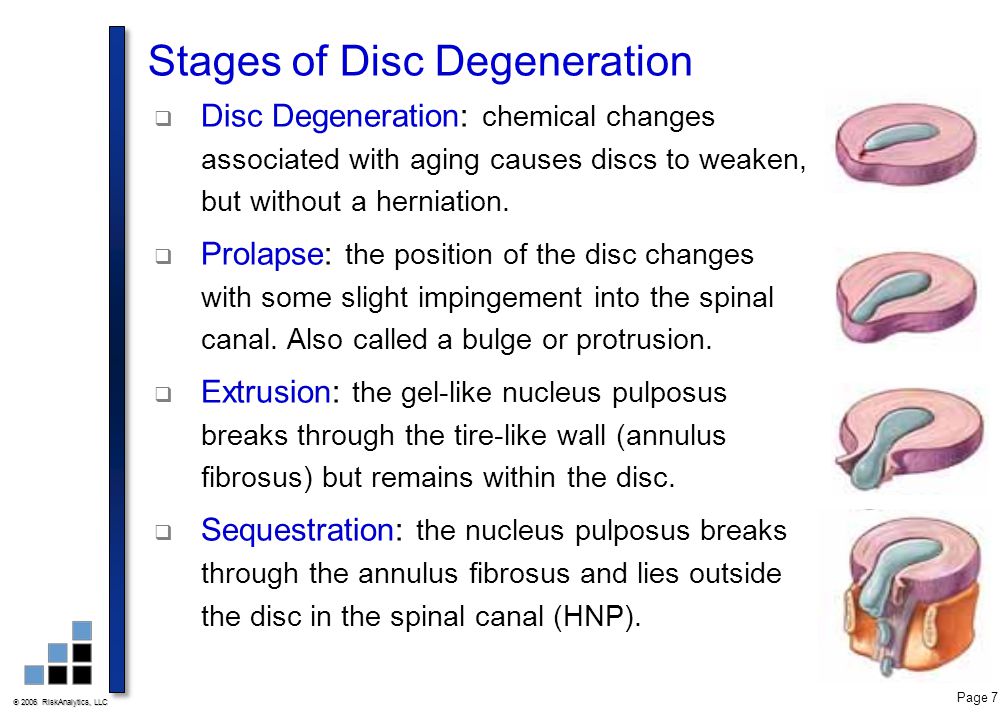 Stages of Disc Degeneration