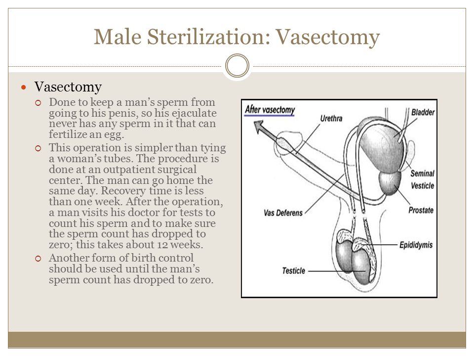 Male Sterilization: Vasectomy