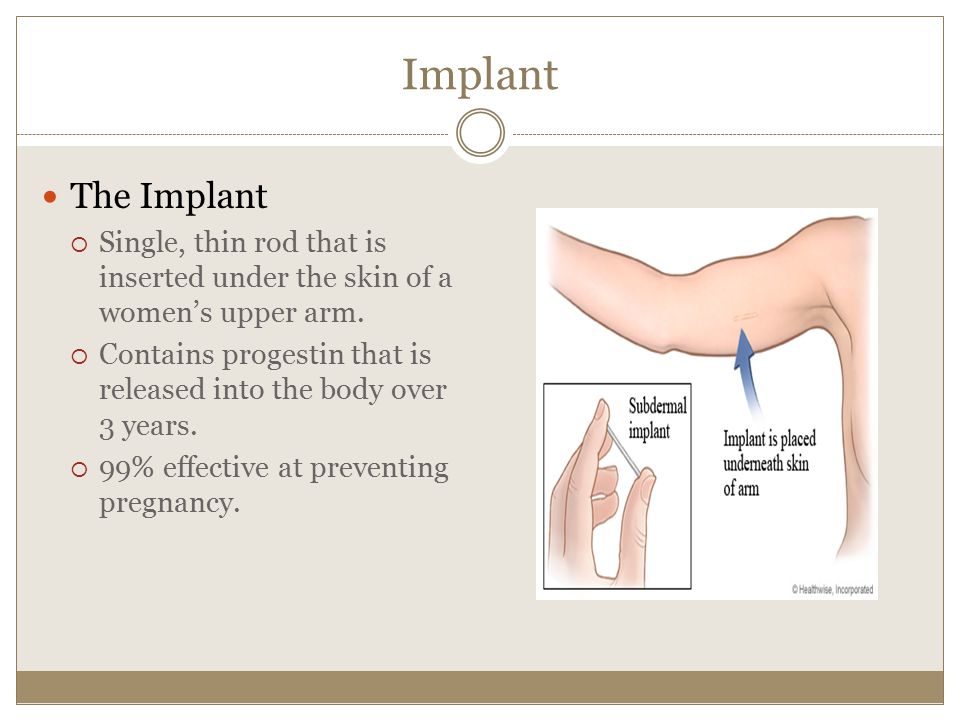 Implant The Implant. Single, thin rod that is inserted under the skin of a women’s upper arm.