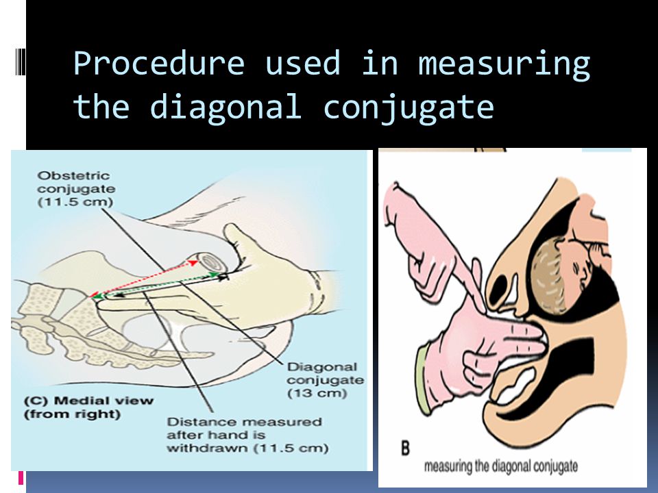 Procedure used in measuring the diagonal conjugate