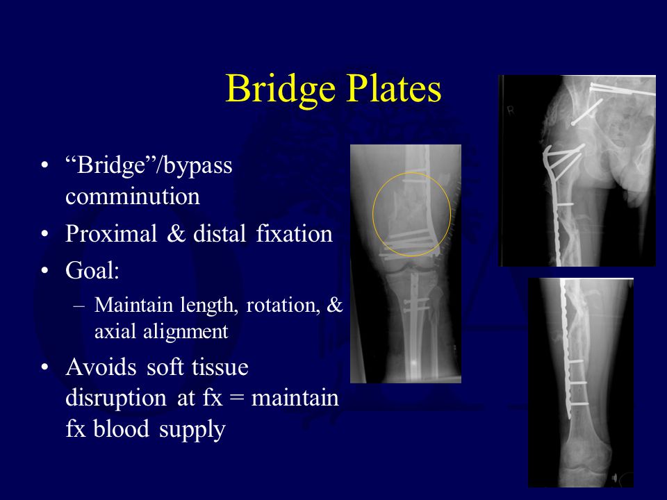 Basic Principles and Techniques of Internal Fixation of Fractures - ppt  video online download