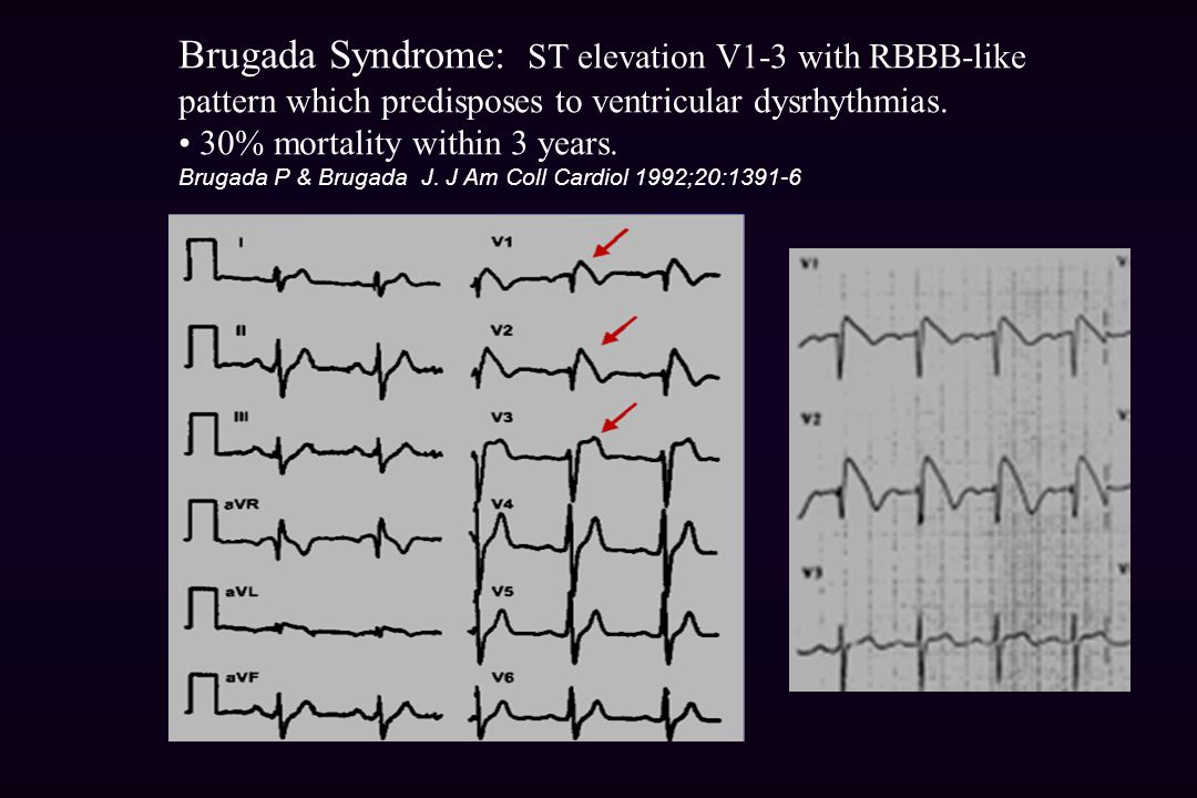 Синдром бругада на экг фото