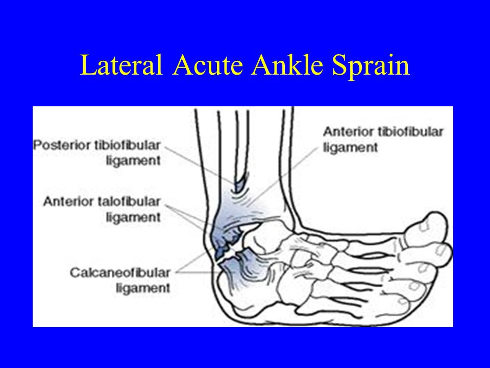 Lateral Acute Ankle Sprain