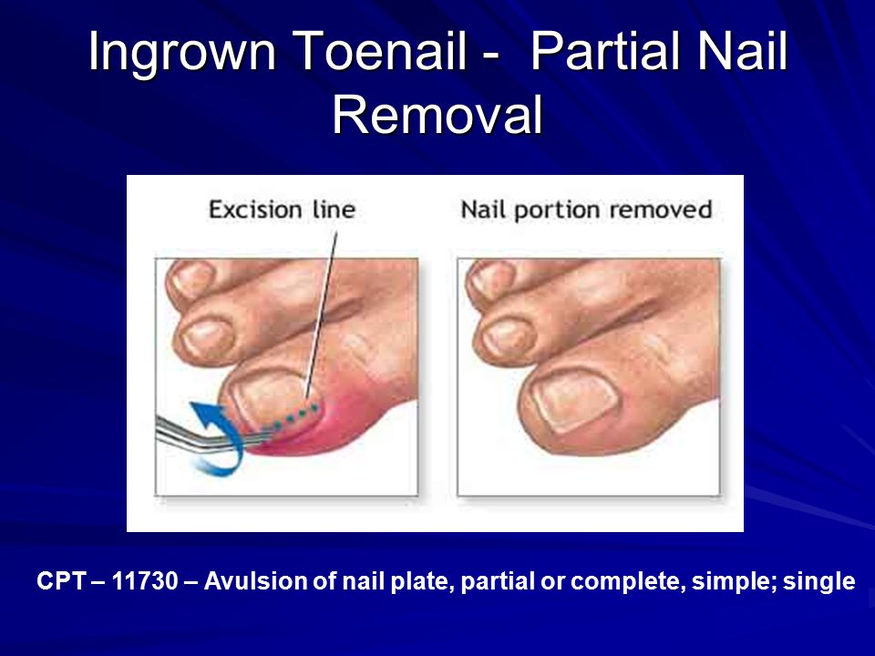 Ingrown+Toenail+ +Partial+Nail+Removal