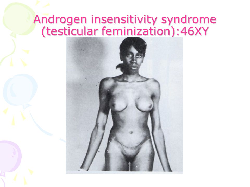 Down Syndrome Girl Nude