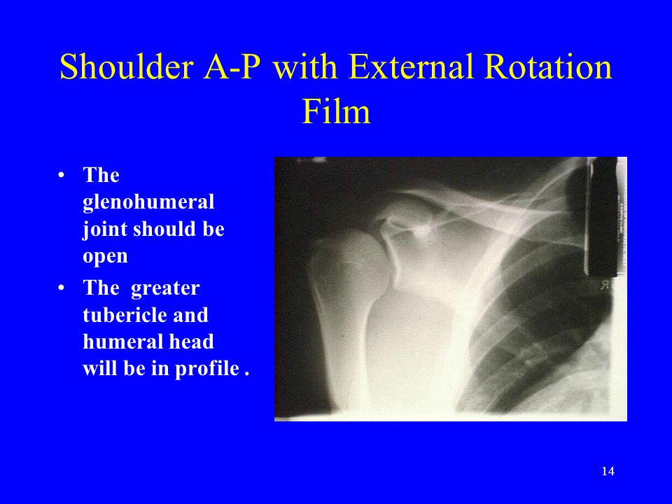 internal rotation shoulder xray