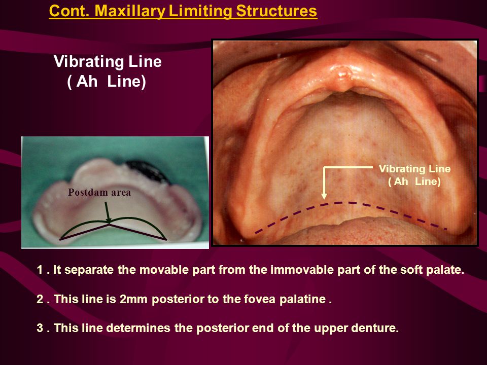 Introduction To Dentures Ppt Video Online Download