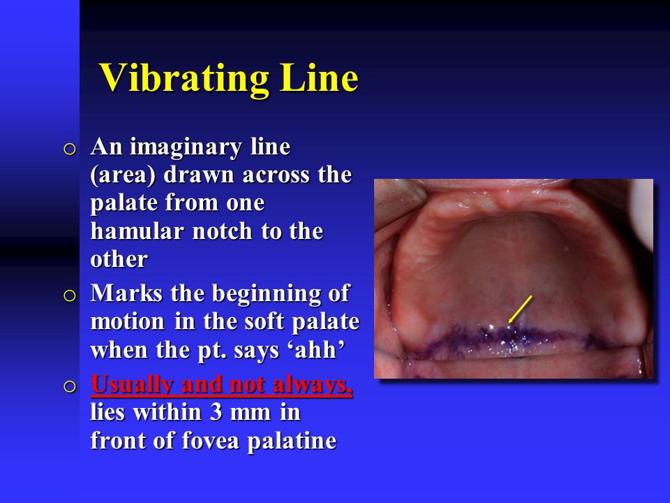 vibrating line