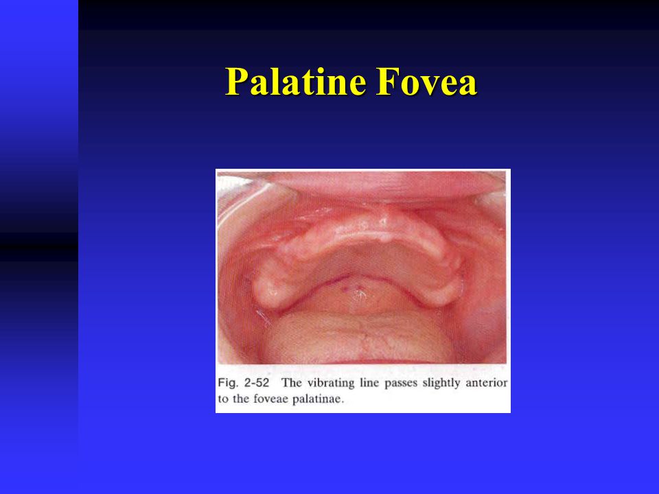 Anatomy Of Maxillary Denture Bearing Area Ppt Video Online Download
