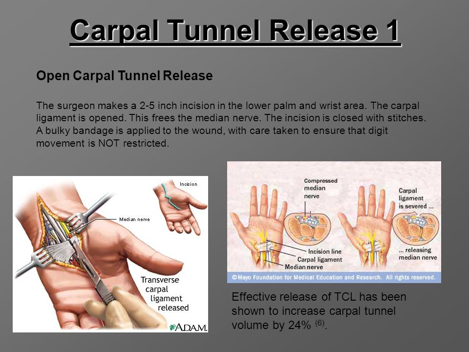 Carpal Tunnel Release 1 Open Carpal Tunnel Release.