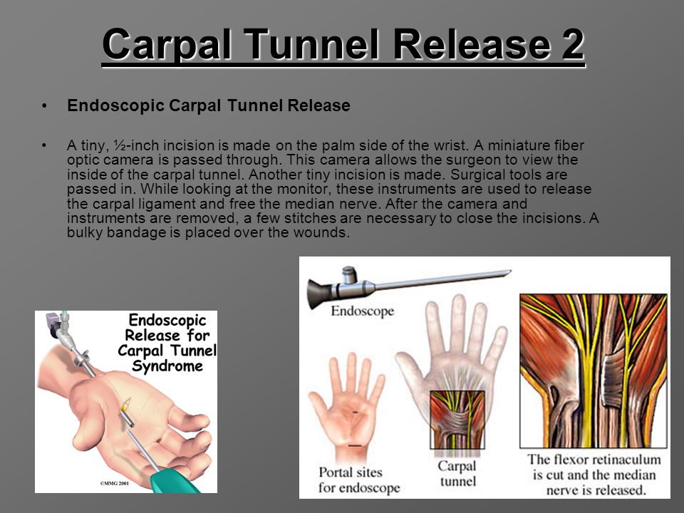carpal tunnel syndrome physiotherapy management ppt