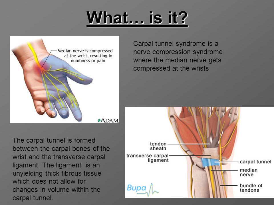 What. is it Carpal tunnel syndrome is a nerve compression syndrome where th...