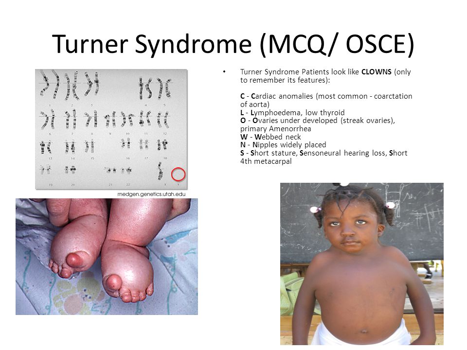 Turner Syndrome (MCQ/ OSCE) .
