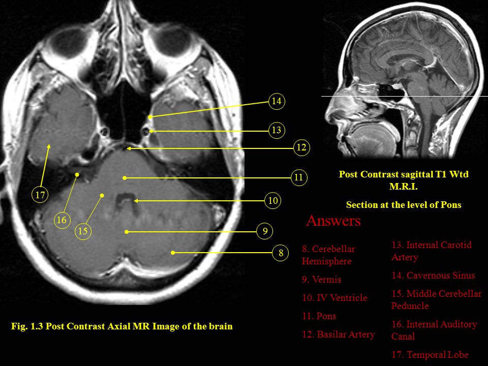 Brain mri anatomy
