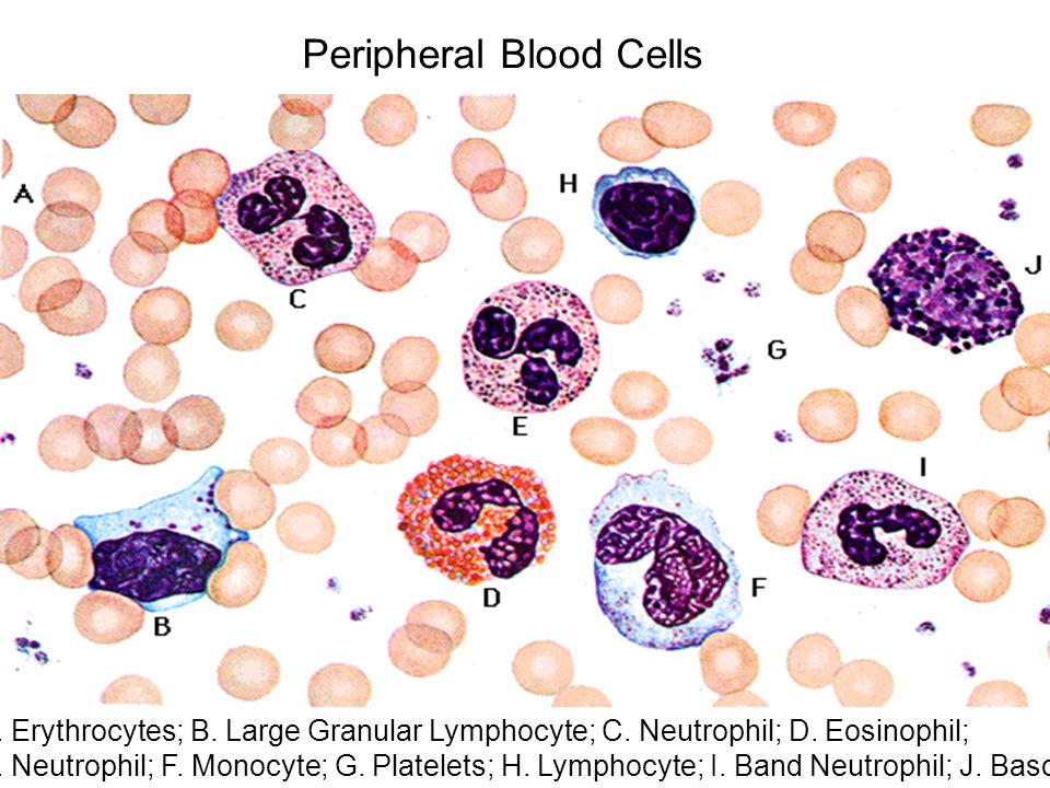 Mature neutrophilia on peripheral blood smear