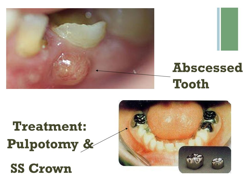 Abscessed Tooth Treatment: Pulpotomy & SS Crown