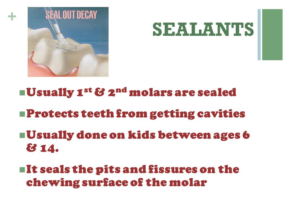 SEALANTS Usually 1st & 2nd molars are sealed