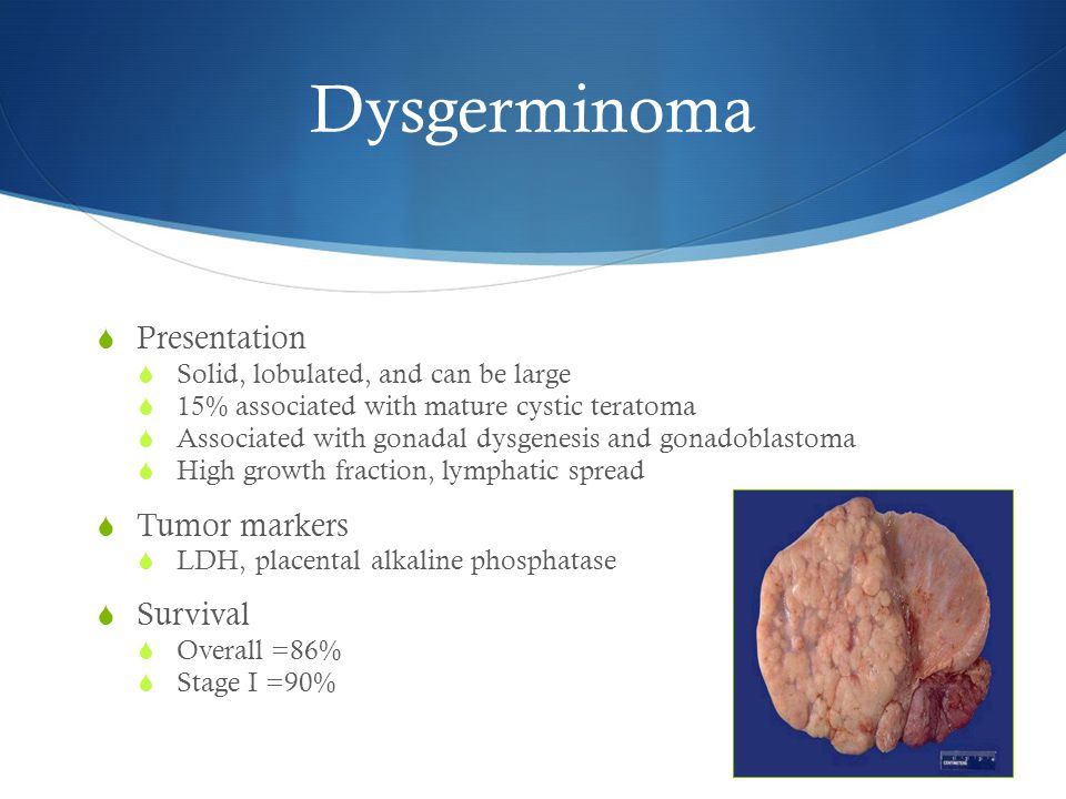 Non-epithelial ovarian cancer - ppt video online download