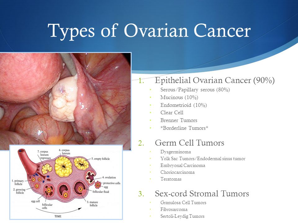 ovarian cancer types epithelial tumors