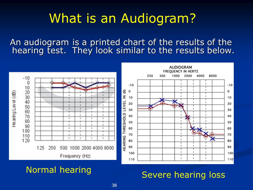 Normal Hearing Test Chart