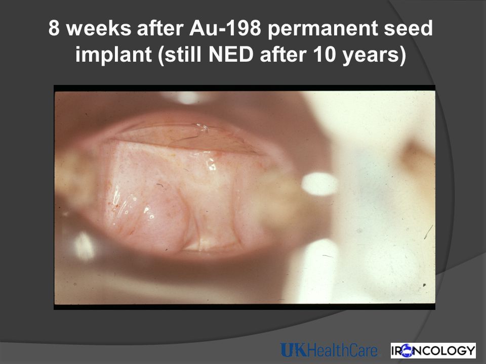 8 weeks after Au-198 permanent seed implant (still NED after 10 years)
