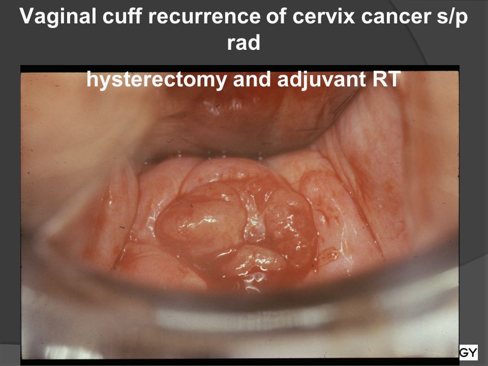Vaginal cuff recurrence of cervix cancer s/p rad