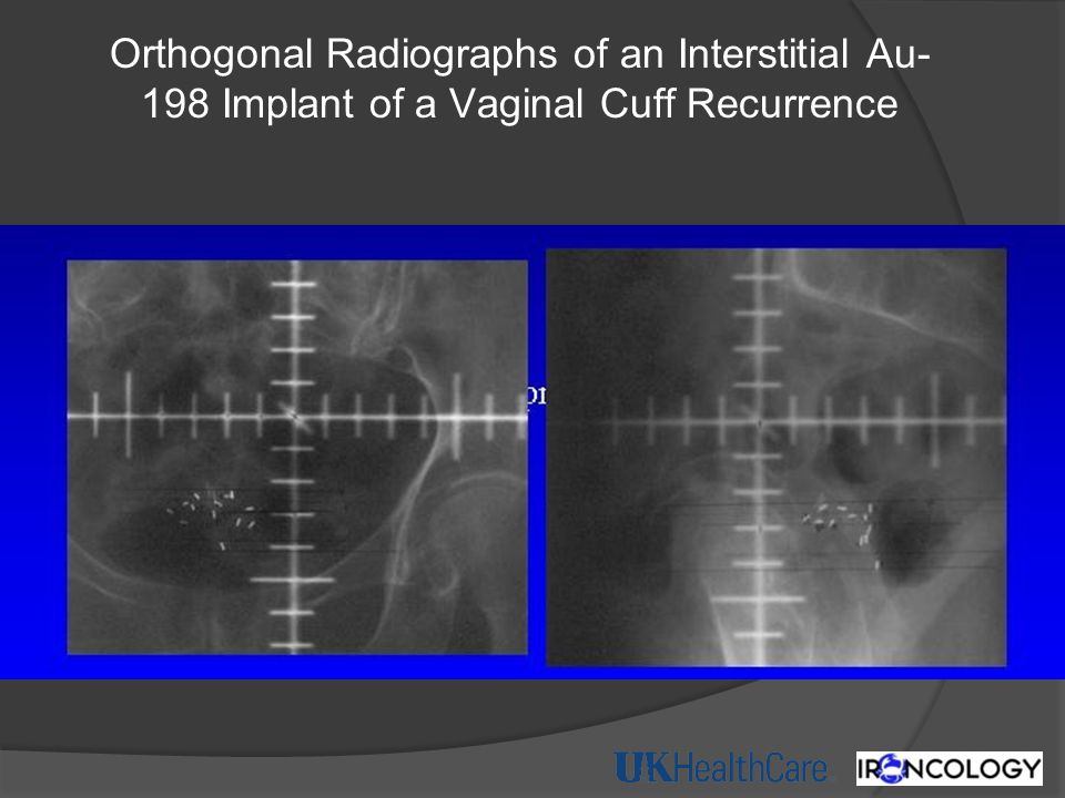 Orthogonal Radiographs of an Interstitial Au-198 Implant of a Vaginal Cuff Recurrence