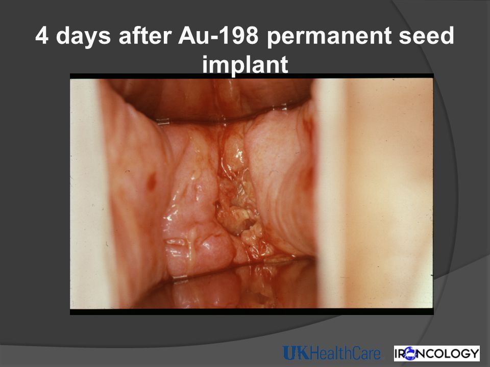 4 days after Au-198 permanent seed implant