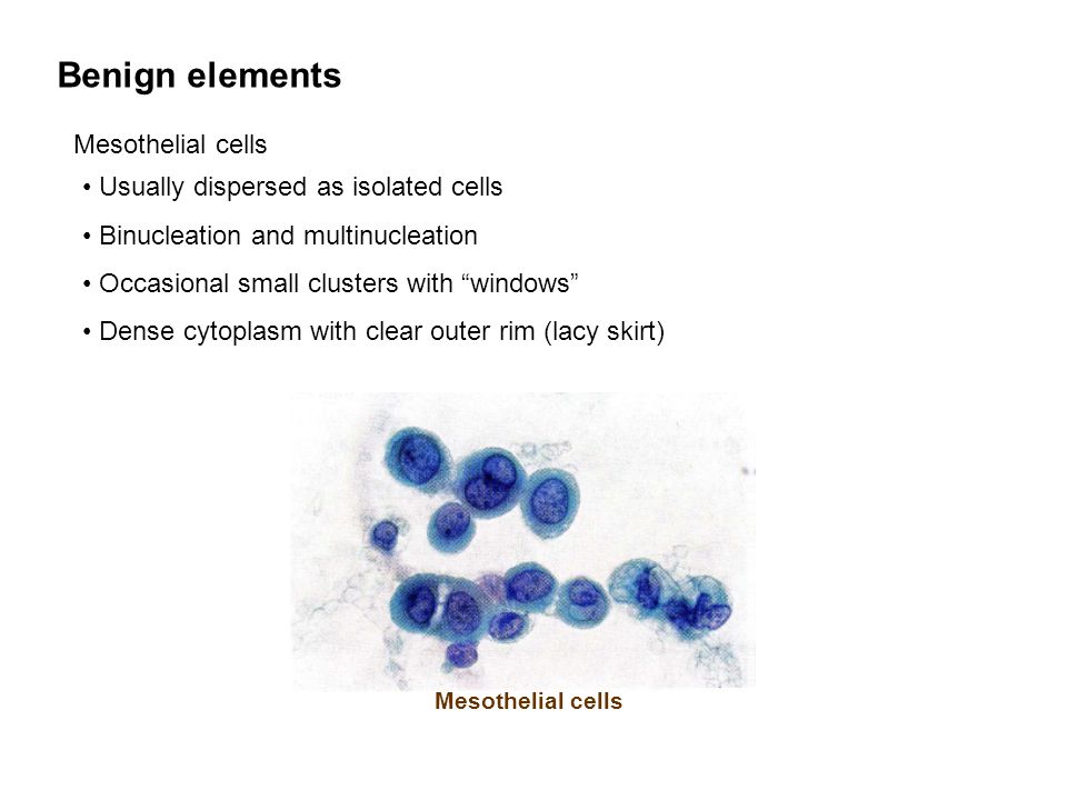 Benign elements Mesothelial cells Usually dispersed as isolated cells