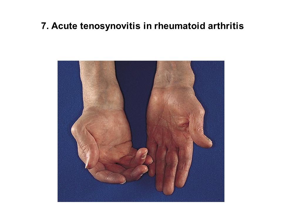 fiatalkori rheumatoid arthritis a boka