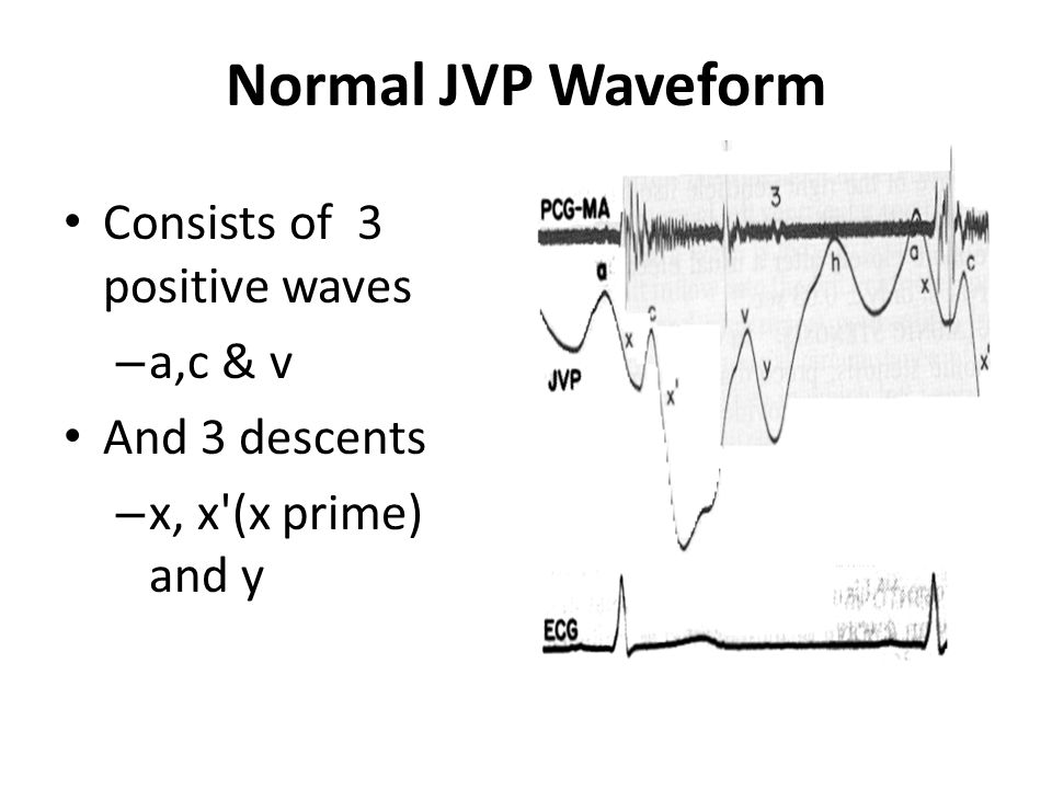 Jugular Venous Pressure And Waveforms Ppt Video Online Download