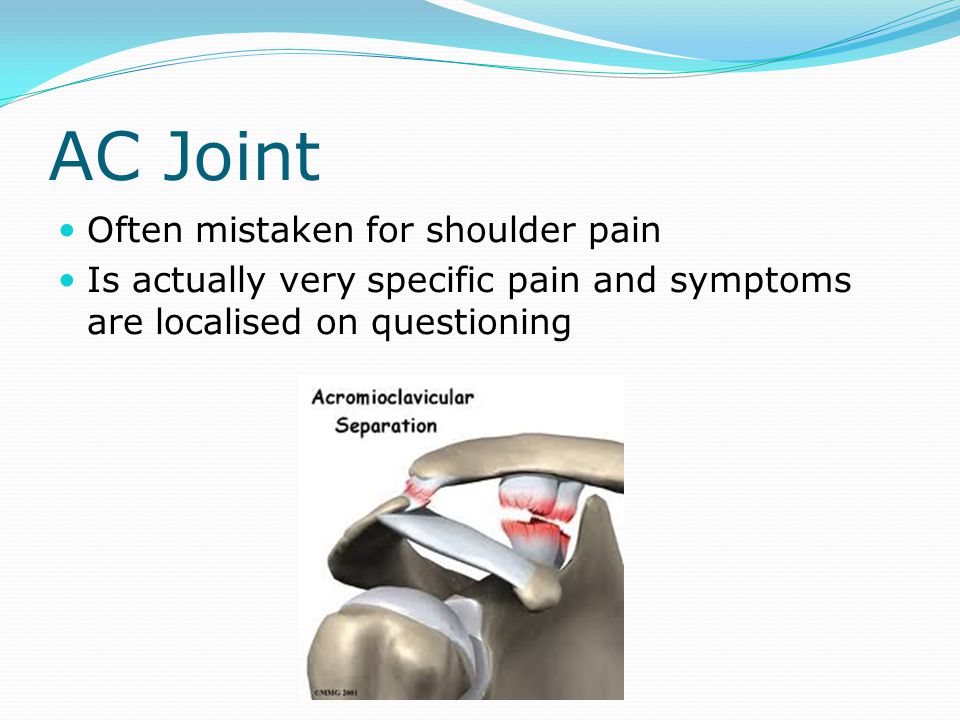 AC Joint Often mistaken for shoulder pain