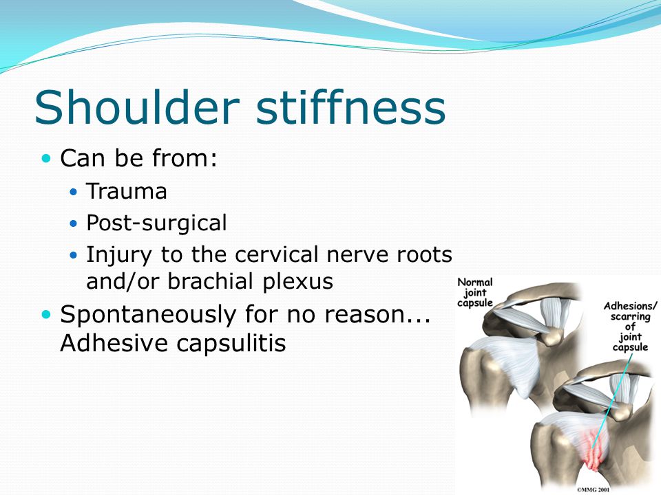Shoulder stiffness Can be from: